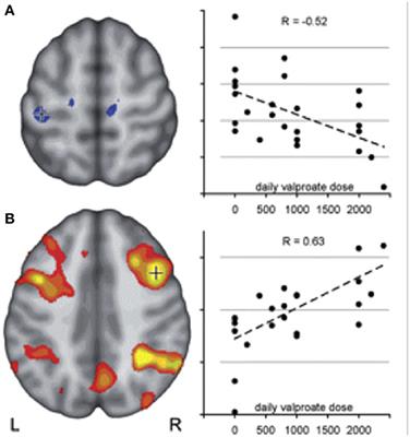 Pharmaco-fMRI: A Tool to Predict the Response to Antiepileptic Drugs in Epilepsy